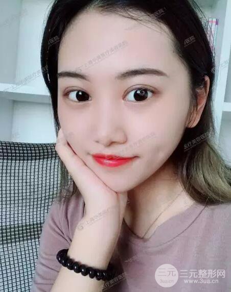 上海華美楊亞益全切雙眼皮案例對(duì)比圖 男女雙眼皮案例混搭