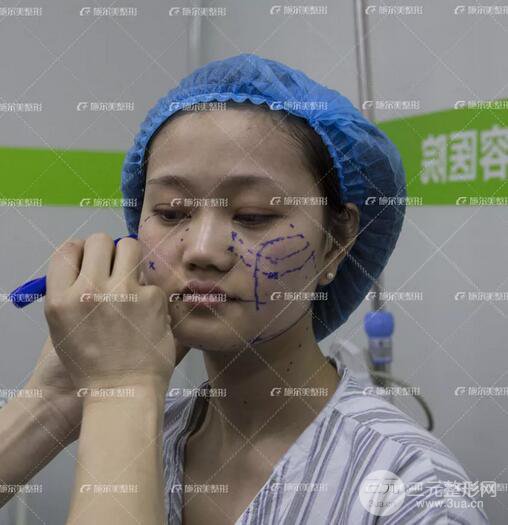 南京施爾美整形孫欣線D案例,重返17歲！