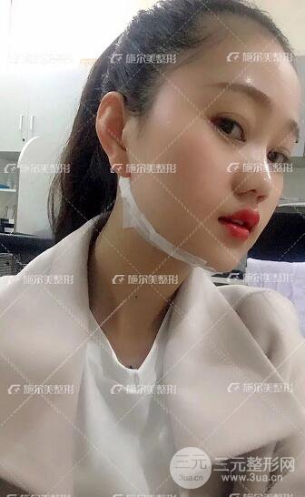 南京施爾美整形孫欣線D案例,重返17歲！