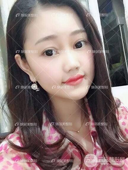 南京施爾美整形孫欣線D案例,重返17歲！