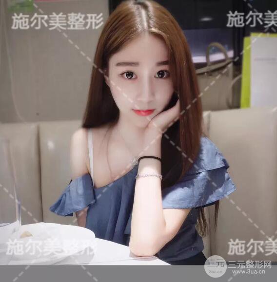 南京施爾美自體脂肪填充案例,拒絕“壽星公”！