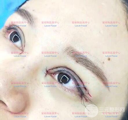 揚(yáng)州艾菲斯黃嬋院長(zhǎng)雙眼皮案例術(shù)后七天果