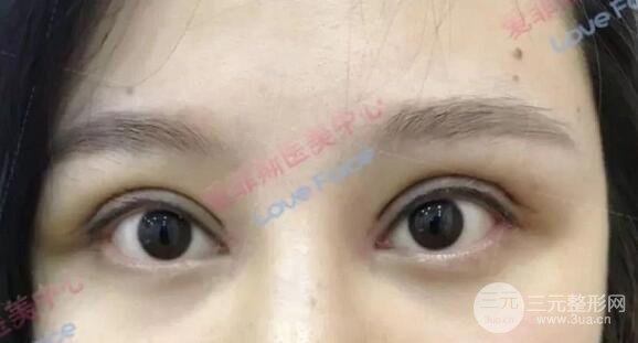揚(yáng)州艾菲斯黃嬋院長(zhǎng)雙眼皮案例術(shù)后七天果