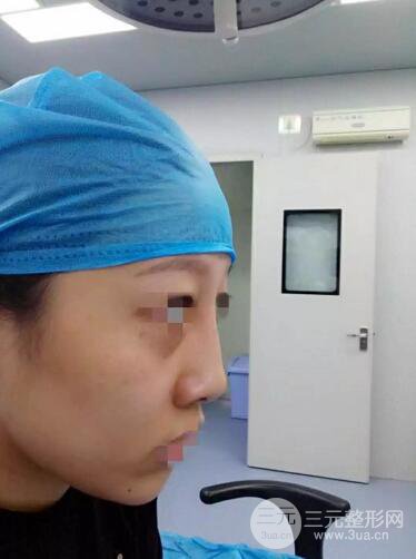 揚州艾菲斯整形隆鼻案例，自拍盛顏不是夢！