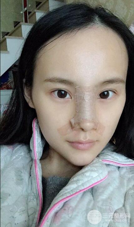 成都大華隆鼻怎么樣?真實案例前后對比圖記錄恢復(fù)過程