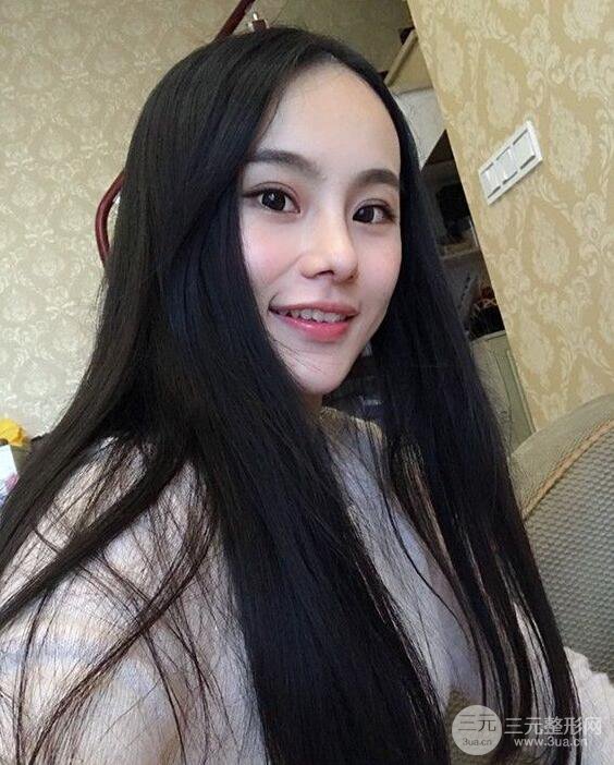 成都大華隆鼻怎么樣?真實案例前后對比圖記錄恢復(fù)過程