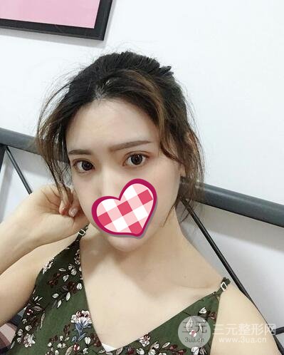 北京玉之光王明利自體脂肪填充全臉案例