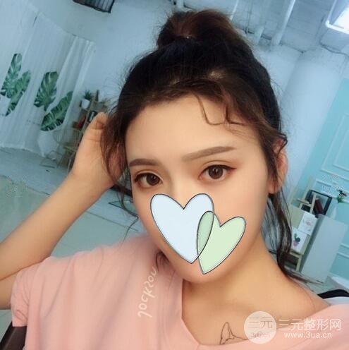 北京玉之光王明利自體脂肪填充全臉案例