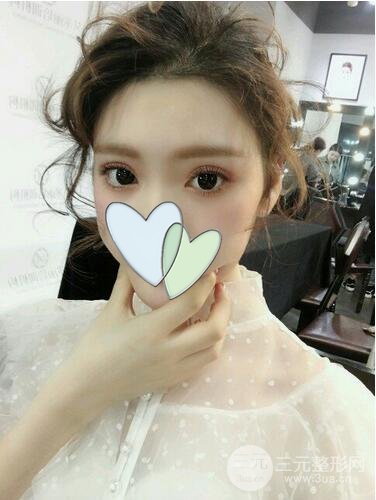 北京玉之光王明利自體脂肪填充全臉案例