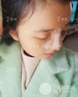 成都素美假體隆鼻案例前后對(duì)比圖分享!