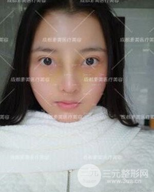 成都素美假體隆鼻案例前后對(duì)比圖分享!