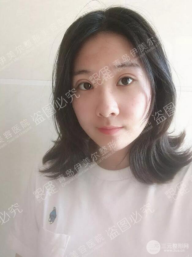 青島伊美爾雙眼皮恢復實記案例對比圖分享