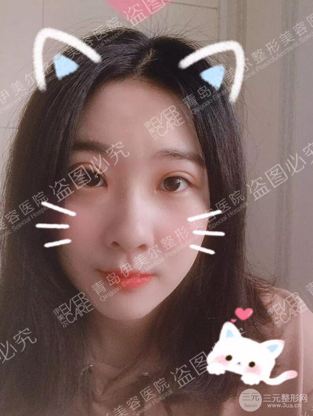 青島伊美爾雙眼皮恢復實記案例對比圖分享