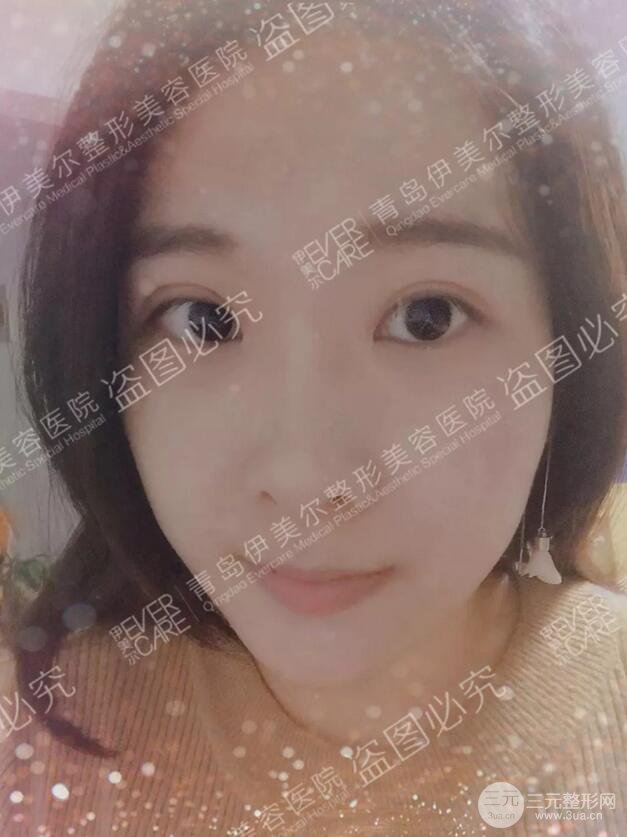青島伊美爾雙眼皮恢復實記案例對比圖分享