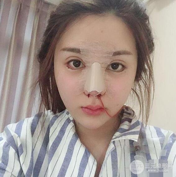 昆明吳氏嘉美李明硅膠隆鼻前后對(duì)比圖恢復(fù)心情小札