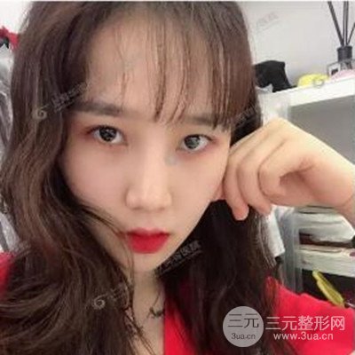 上海華美李志海隆鼻整形案例前后對比圖分享~