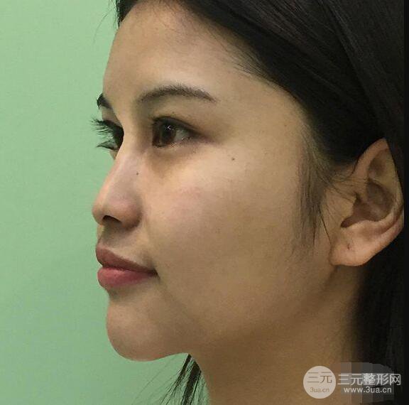 成都華西醫(yī)院整形美容科卿勇隆鼻整形前后對(duì)比圖恢復(fù)心情小札