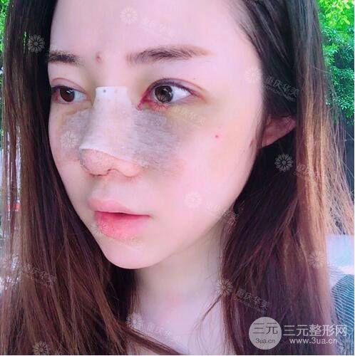 重慶華美何春濤假體隆鼻案例過(guò)程恢復(fù)分享