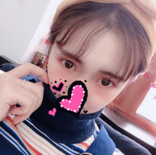 揚(yáng)州艾菲斯黃嬋雙眼皮案例術(shù)后恢復(fù)果