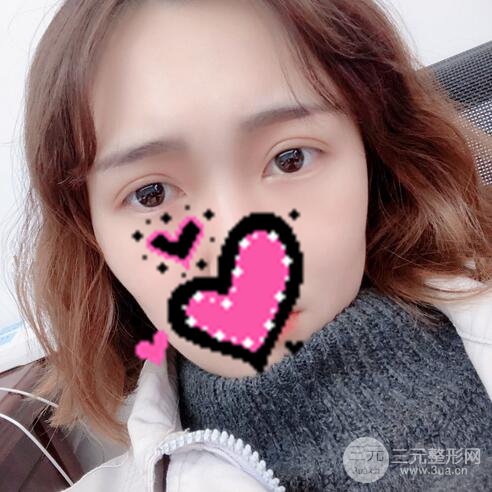 揚(yáng)州艾菲斯黃嬋雙眼皮案例術(shù)后恢復(fù)果