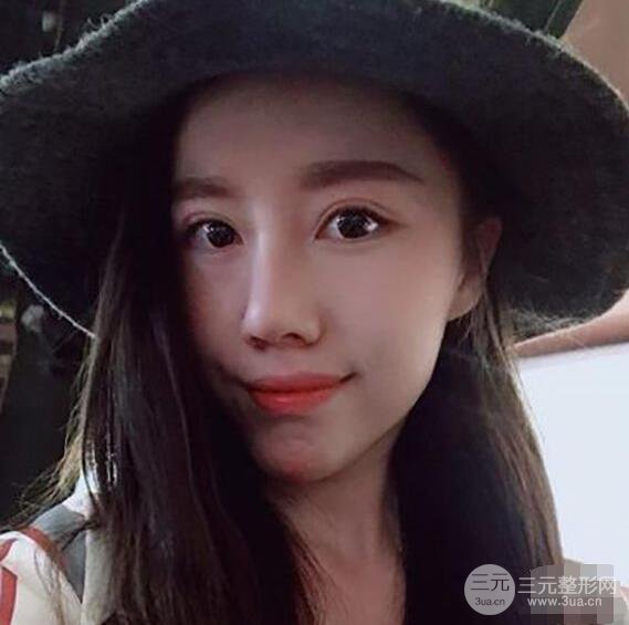 北京聯(lián)合麗格吳焱秋耳軟骨隆鼻前后對(duì)比圖|塌鼻子的救星