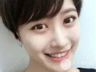 成都藝星切開雙眼皮+隆鼻整形日記分享