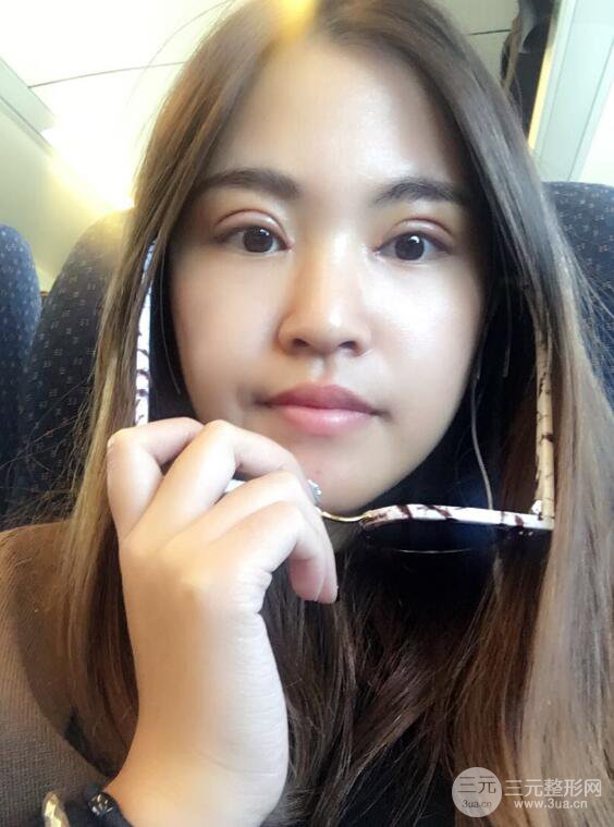 沈陽百嘉麗葉微微切開雙眼皮前后對比圖恢復(fù)心情小札