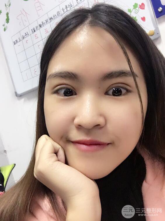 沈陽百嘉麗葉微微切開雙眼皮前后對比圖恢復(fù)心情小札