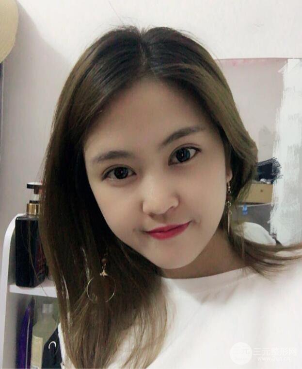 沈陽百嘉麗葉微微切開雙眼皮前后對比圖恢復(fù)心情小札