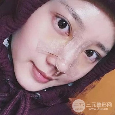 硅膠假體隆鼻案例前后對比圖分享！顏值變化驚人！