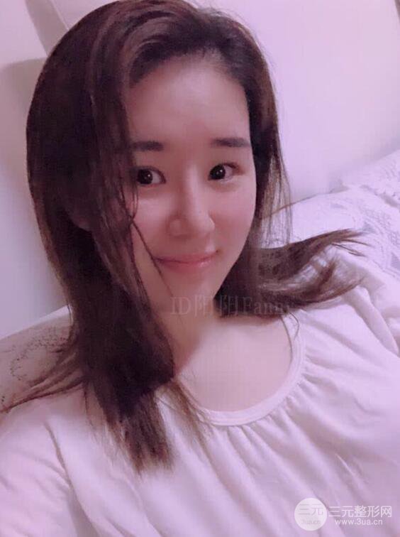 上海華美李庭勛假體隆鼻前后對(duì)比圖一個(gè)月恢復(fù)心情日記