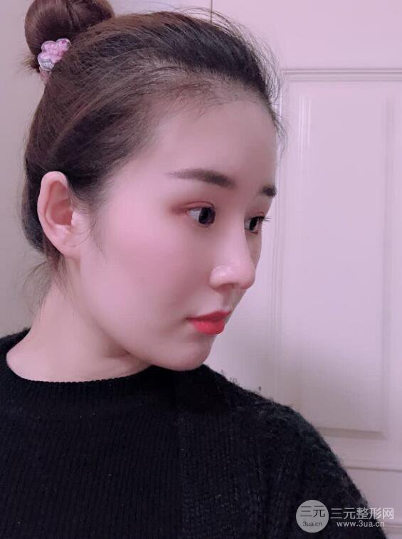 上海華美李庭勛假體隆鼻前后對(duì)比圖一個(gè)月恢復(fù)心情日記