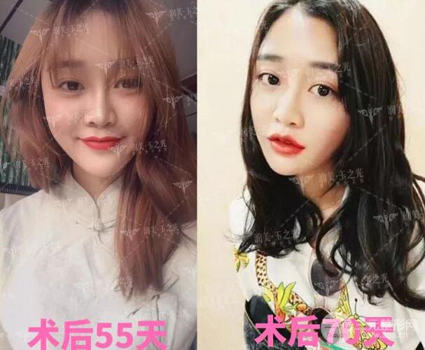 北京玉之光自體脂肪面部填充案例