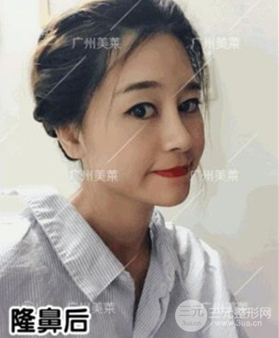 廣州美萊自體軟骨隆鼻案例前后對比圖分享!