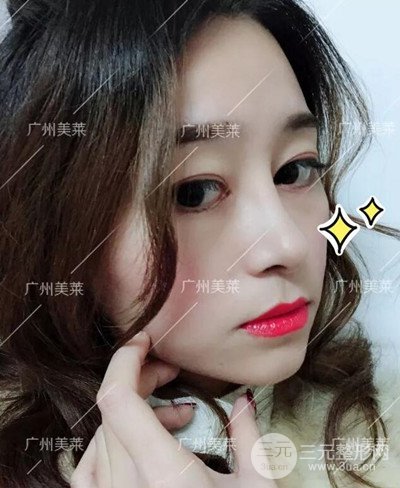 廣州美萊自體軟骨隆鼻案例前后對比圖分享!