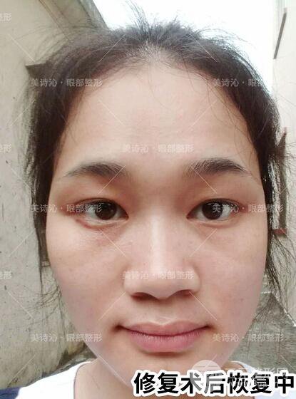 北京詩(shī)美沁祛眼袋案例術(shù)后果分享！
