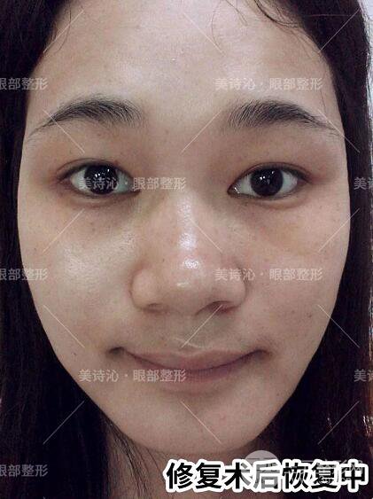 北京詩(shī)美沁祛眼袋案例術(shù)后果分享！