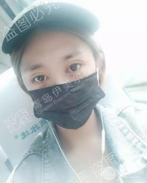 青島伊美爾5s雙眼皮案例術(shù)后恢復(fù)果圖記錄