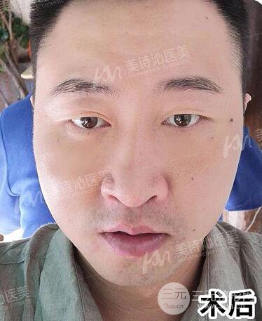 北京詩(shī)美沁祛眼袋案例，男士微創(chuàng)祛眼袋果分享！