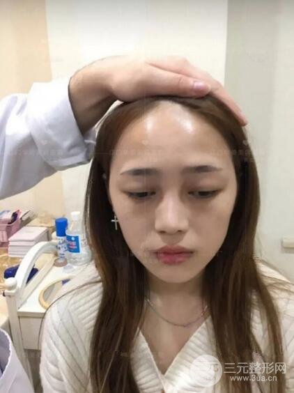 重慶愛(ài)思特整形隆鼻案例術(shù)后恢復(fù)果分享！