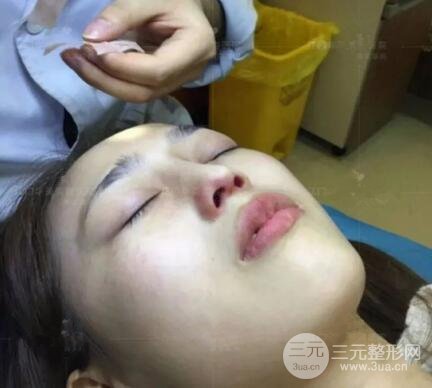 重慶愛(ài)思特整形隆鼻案例術(shù)后恢復(fù)果分享！