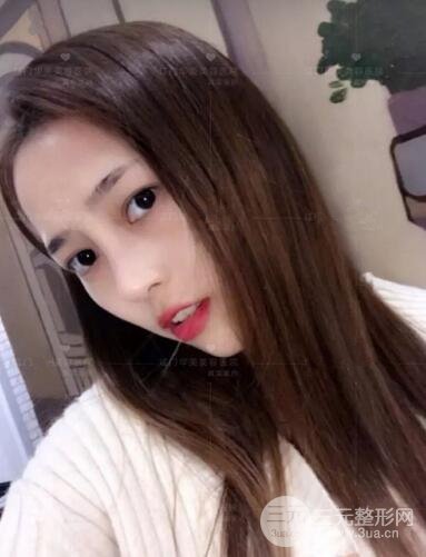 重慶愛(ài)思特整形隆鼻案例術(shù)后恢復(fù)果分享！