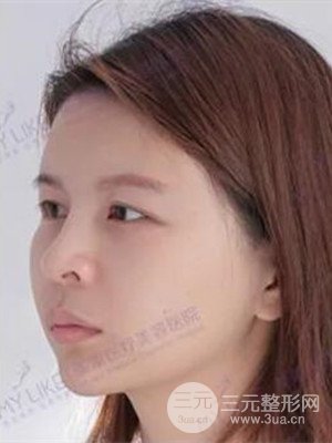 沈陽美萊高國林自體脂肪填充面部案例前后對(duì)比果圖分享