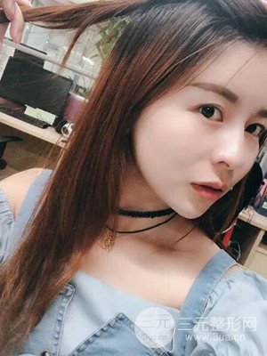 沈陽美萊高國林自體脂肪填充面部案例前后對(duì)比果圖分享