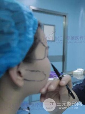 沈陽美萊高國林自體脂肪填充面部案例前后對(duì)比果圖分享