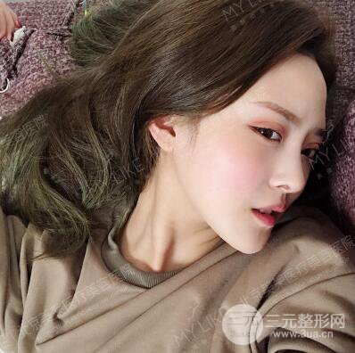 北京美萊趙峻賢隆鼻整形真實(shí)案例對(duì)比圖恢復(fù)過程分享