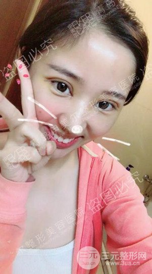 青島伊美爾5s重瞼術(shù)日記分享