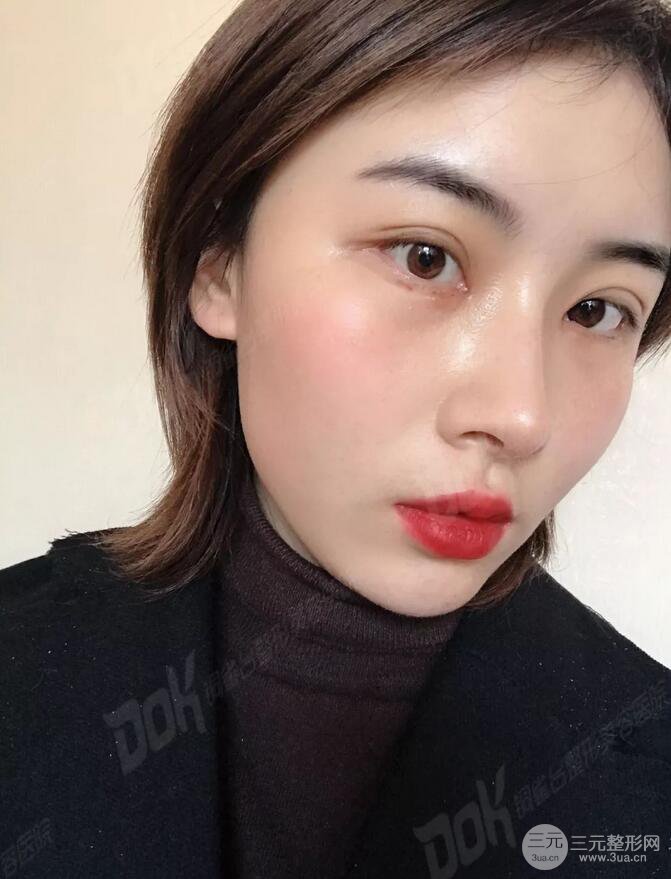 成都銅雀臺切開雙眼皮-45°原生開內(nèi)眼角案例分享~