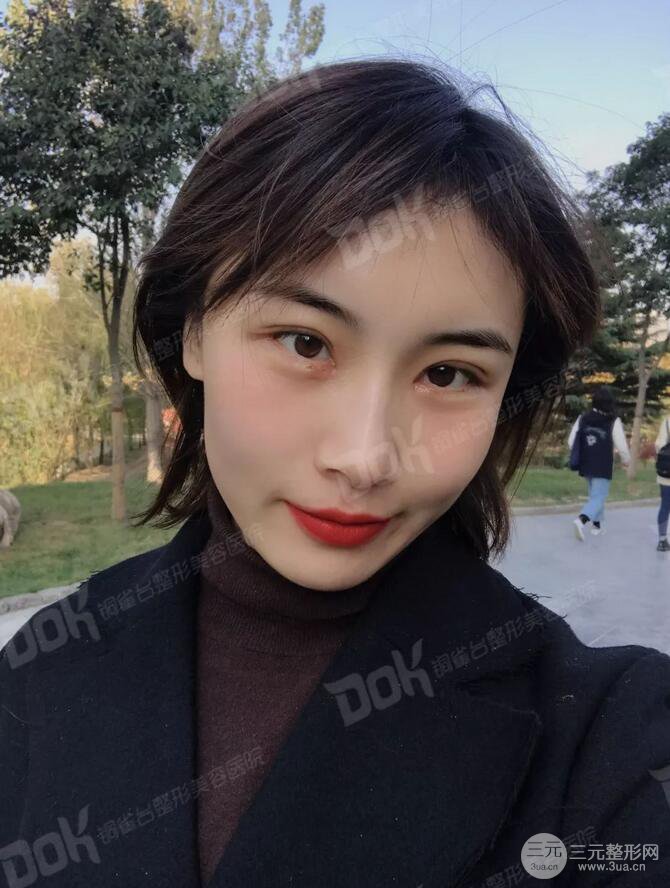 成都銅雀臺切開雙眼皮-45°原生開內(nèi)眼角案例分享~