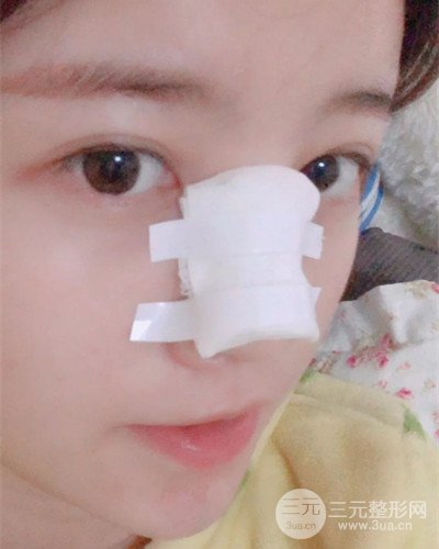 成都天使之翼金輝假體隆鼻案例前后對(duì)比圖分享~